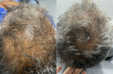Assinatura de Regeneração Capilar